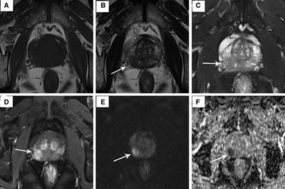 Ki67 and the apparent diffusion coefficient in postoperative prostate cancer with endocrine therapy